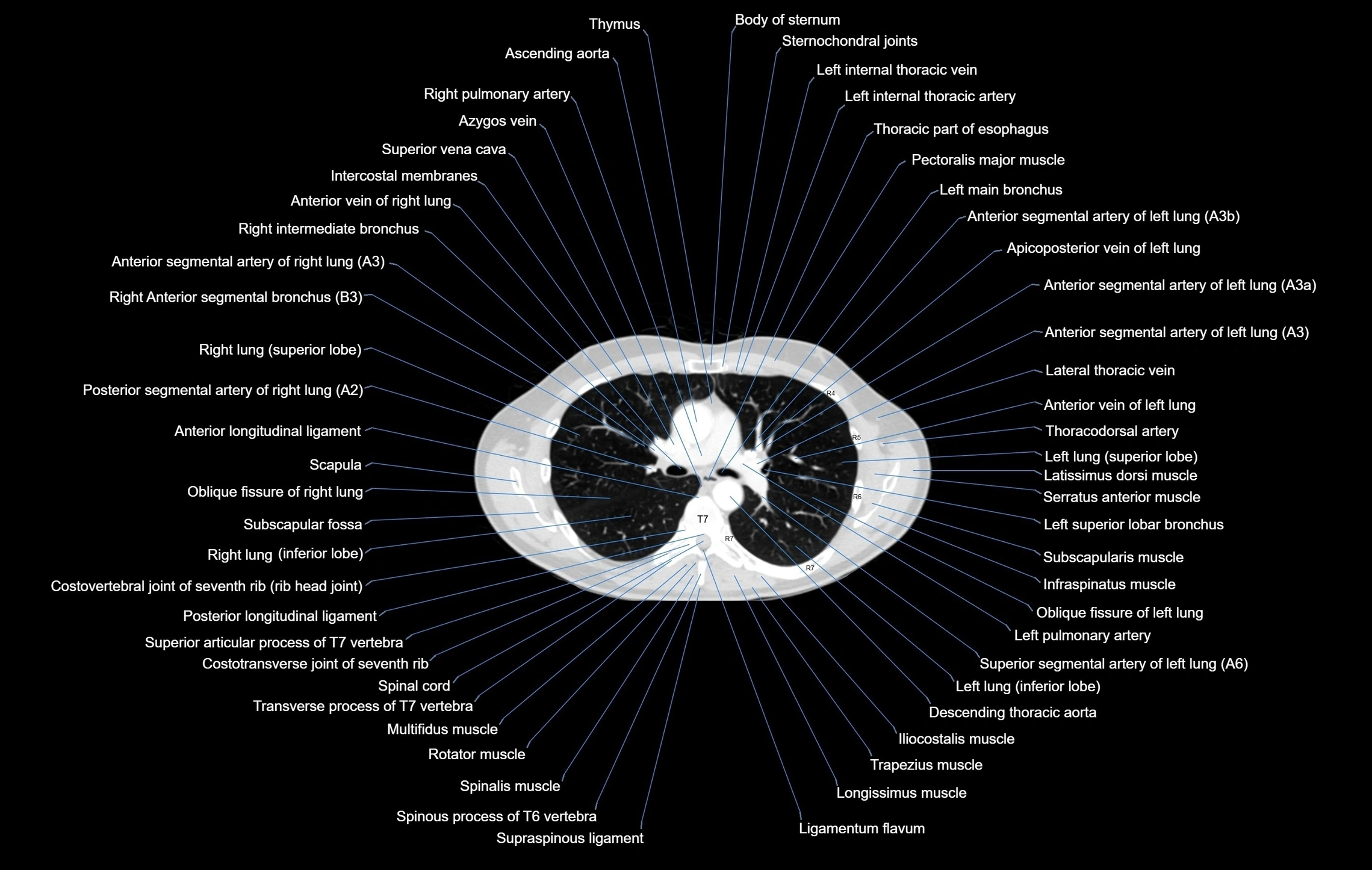 CT chest (thorax) lung window window labelled axial cross sectional anatomy radiology image-00053.webp